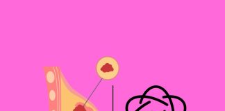 Cómo TumorSight de SimBioSys está revolucionando la cirugía del cáncer de mama con IA y modelos 3D