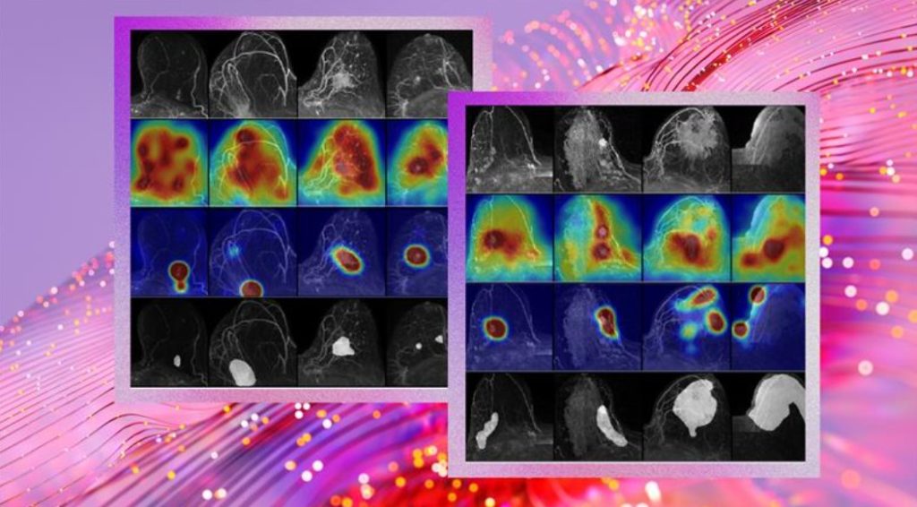 fcdd-deteccion-cancer-de-mama-microsoft-universidad-Washington