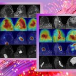 fcdd-deteccion-cancer-de-mama-microsoft-universidad-Washington