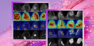 fcdd-deteccion-cancer-de-mama-microsoft-universidad-Washington